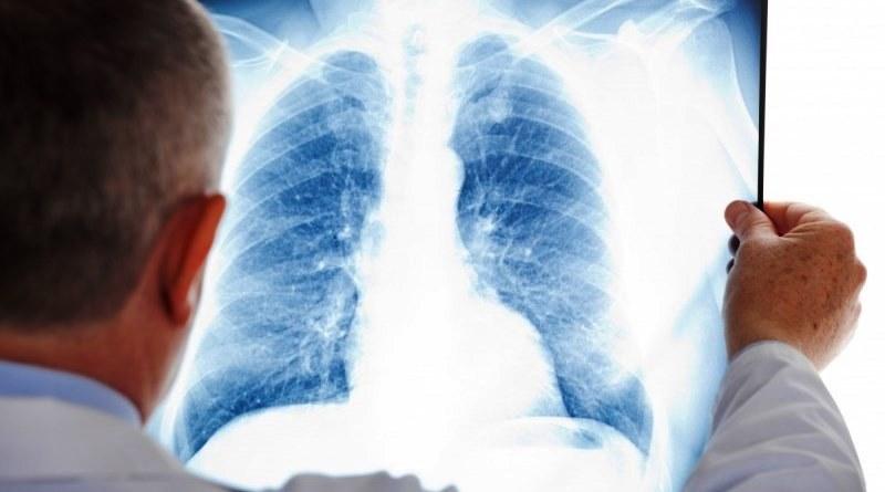 Туберкулезных больных в Павлограде теперь будут лечить по-новому